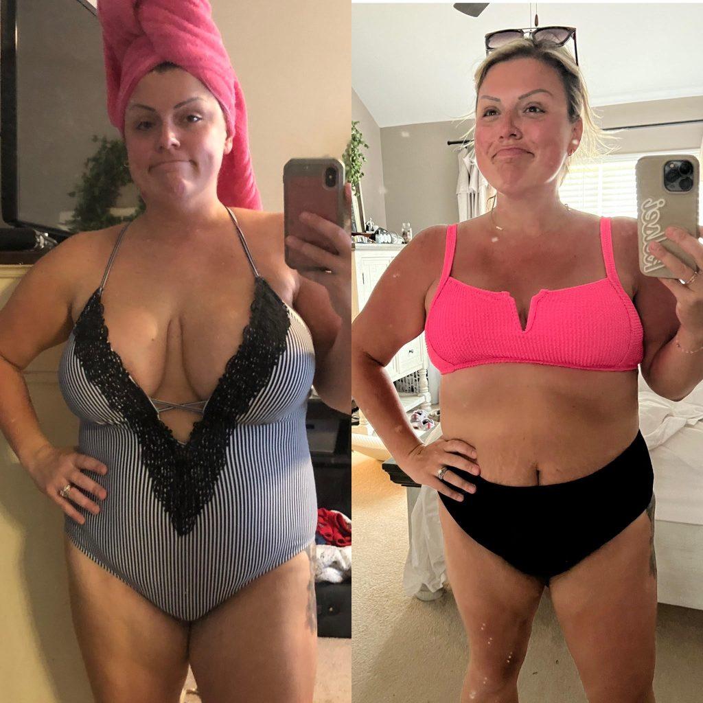 a side by side photo of a woman in a bathing suit. the photo on the left is prior to breast reduction surgery and she is wearing a one piece bathing suit. the photo on the right is after surgery and she's confidently wearing a two piece bathing suit.
