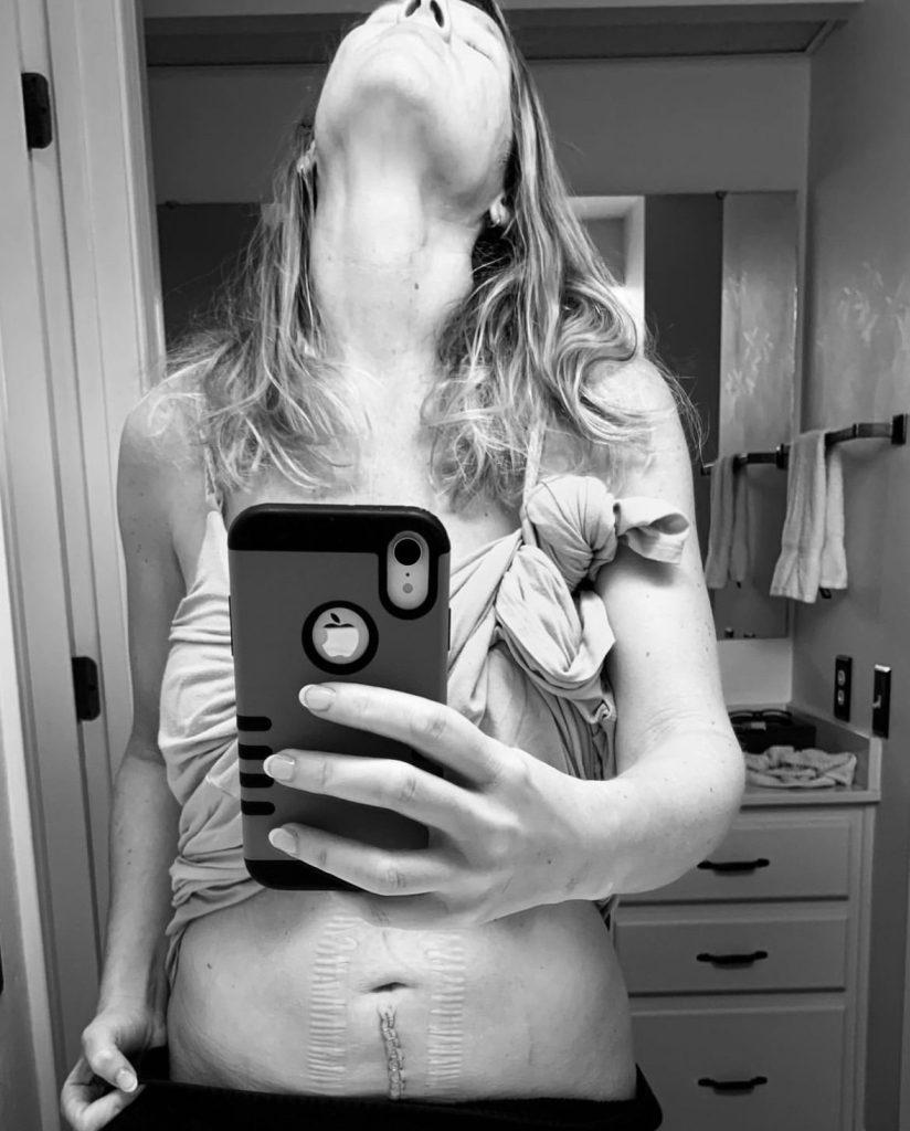 a black and white phot of a woman standing in front of the bathroom mirror with an abdominal scar. The photo is a selfie and her head is flung back. 